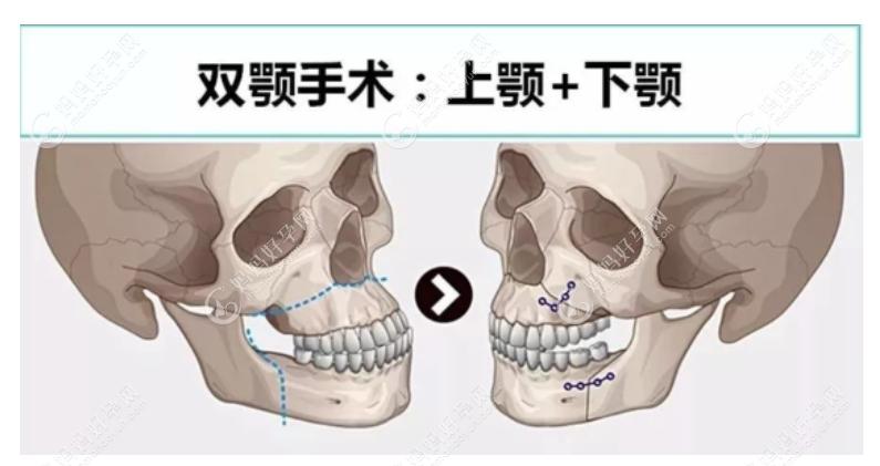 偏颌正颌手术怎么做
