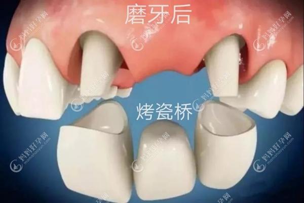 固定义齿一般要磨掉两边的牙齿www.mamahaoyun.com