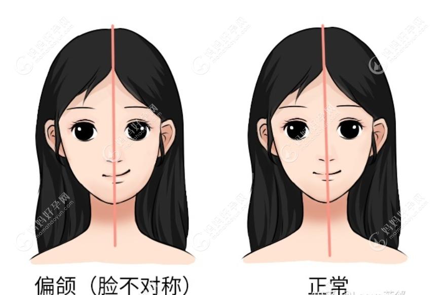 偏颌正颌手术后脸型改变图