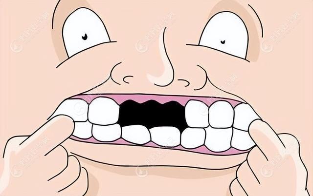 上牙半口假牙如何固定?半口种植牙/半口吸附性义齿/活动牙..
