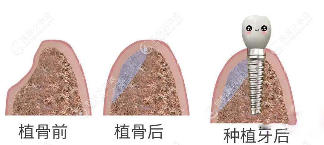 种植牙植骨过程