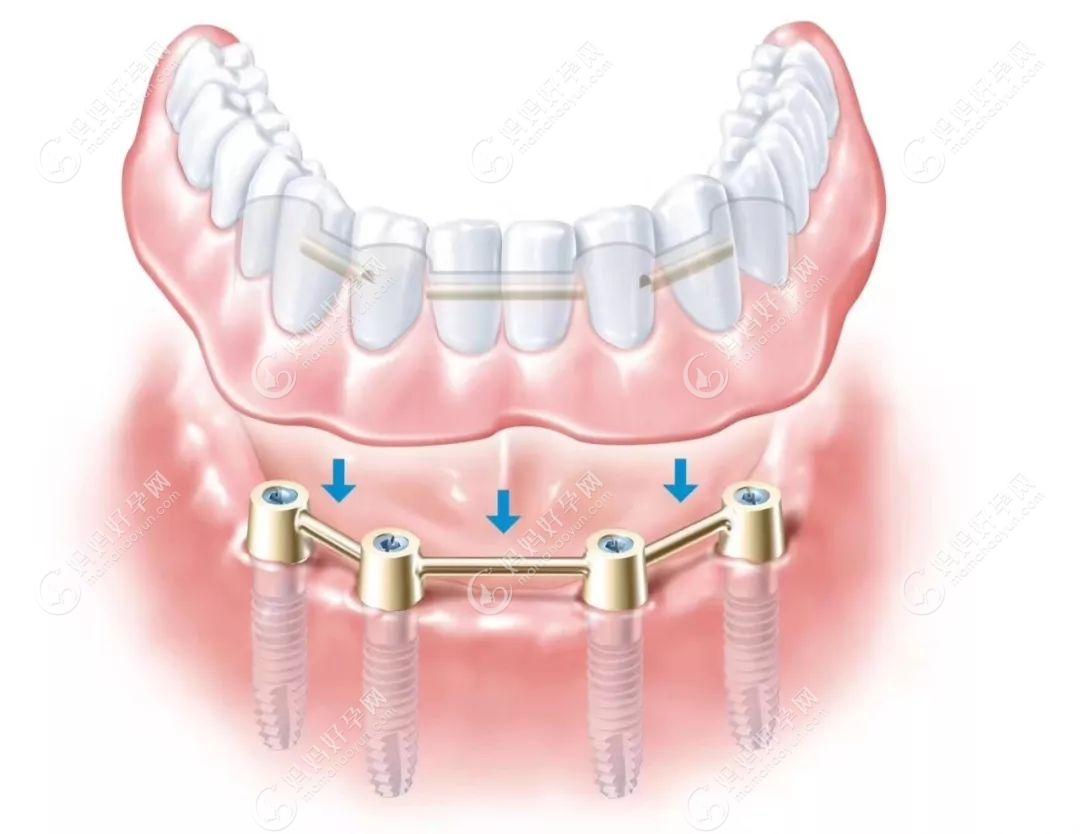 什么叫半固定种植牙?含半、全口半固定种牙过程/价格/图片