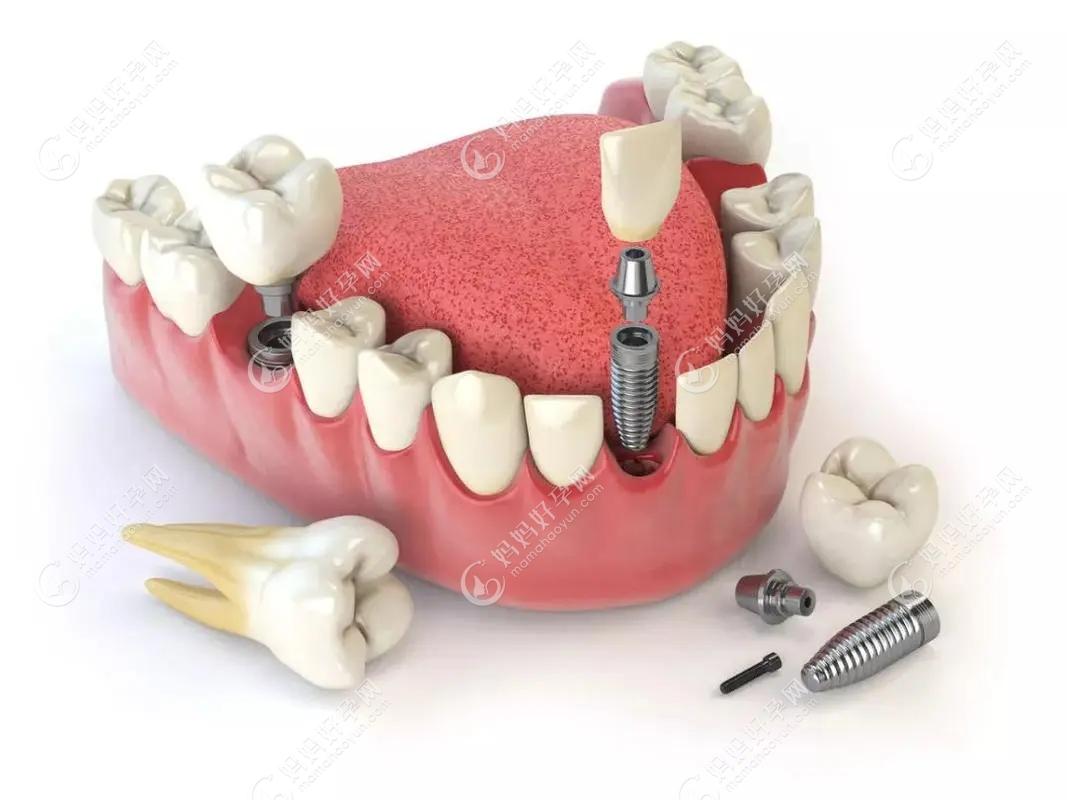 安徽种植牙集采新消息:种植牙未纳入医保政策但价格不超4280