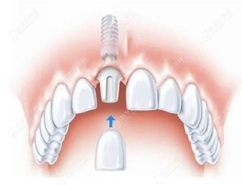 种植牙有8个后遗症:来听种植牙有什么风险以及术后注意事项