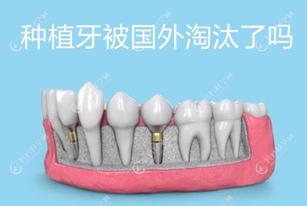 种植牙已被国外淘汰了是吗,听说日本德国都已禁止种植牙了?