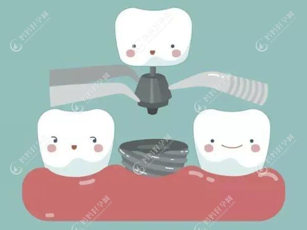 公布广州越秀区种植牙价格,附赠越秀区种牙好的牙科给你们!