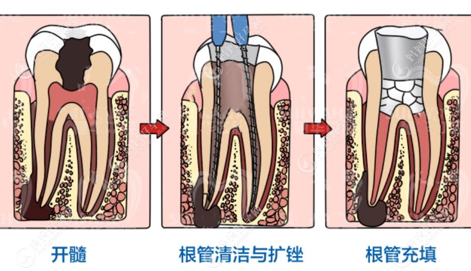 做了根管治疗还能做牙齿矫正吗？根管充填完善可以做正畸