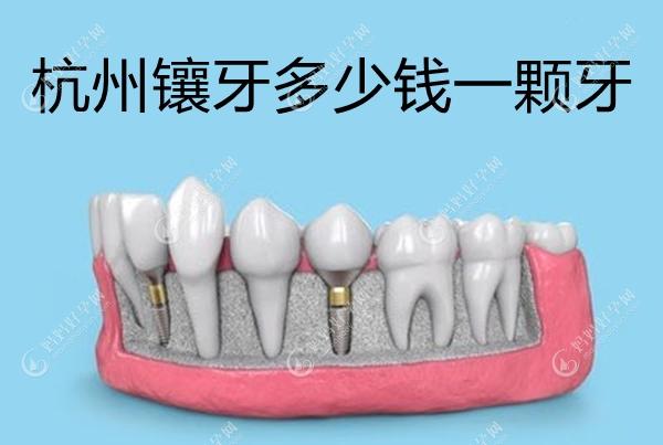 杭州镶牙多少钱一颗牙,杭州种牙3980+,烤瓷牙900+,活动假牙...