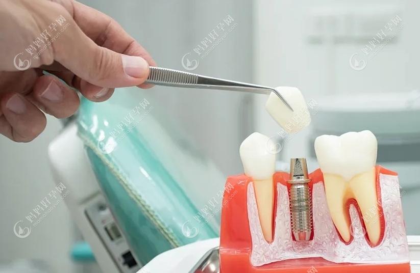 韶关种植牙医院排名前十及韶关种牙便宜又好的地址公布