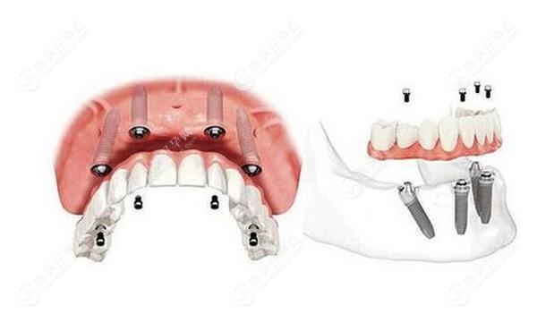 半口牙缺失的治疗方法合集mamahaoyun.com