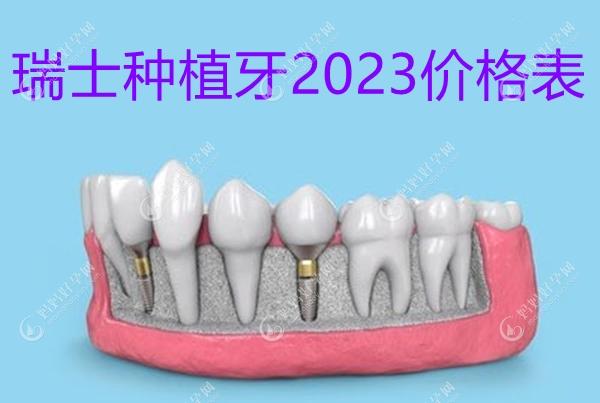 从瑞士种植牙2023价格表中发现瑞士的种植牙12000不算贵