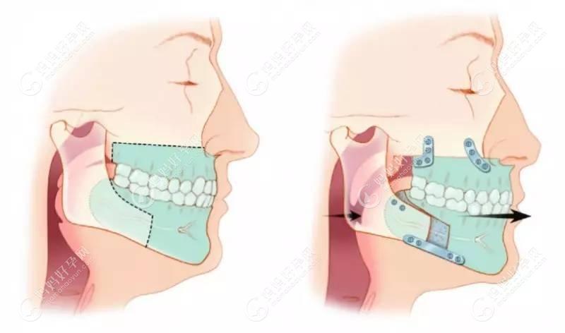 正颌手术和正畸的区别是什么