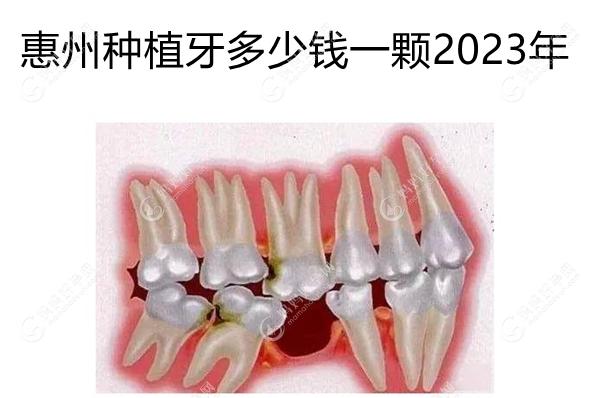 惠州种植牙多少钱一颗2023年,这有惠州种牙价格表可参考