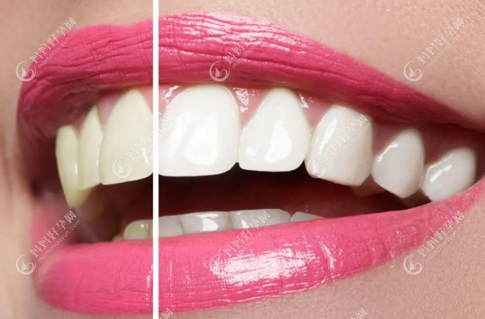 牙齿发黄是什么原因导致冷光美白牙贴面烤瓷牙可以改善