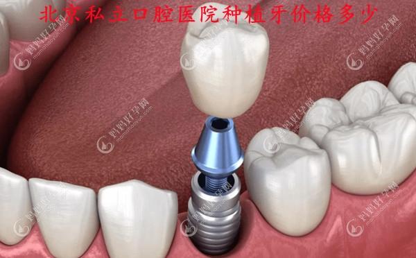 北京私立口腔医院种植牙价格多少钱