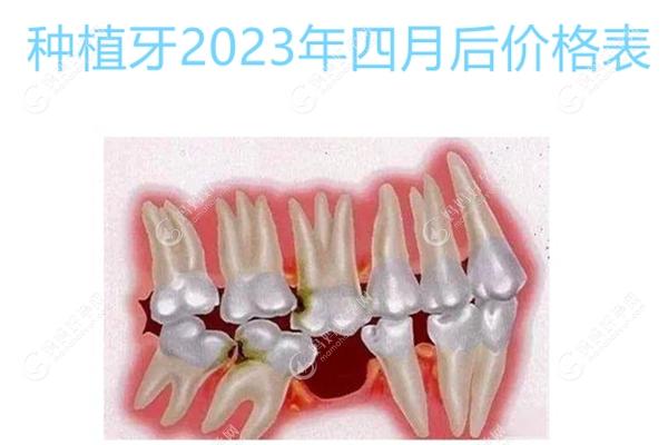 种植牙2023年四月后价格表:集采新政策中种颗士卓曼873+,韩系.