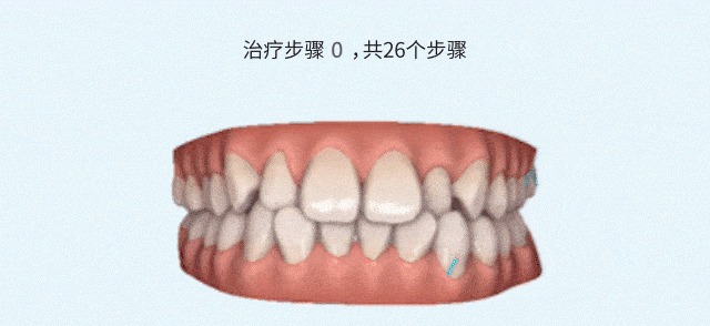 儿童隐形牙齿矫正步骤mamahaoyun.com