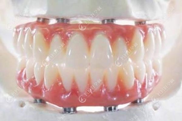 全口种植牙的图片www.mamahaoyun.com