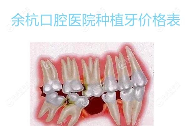 余杭口腔医院种牙价格表:含余杭种牙一颗集采价2580+,半口牙.