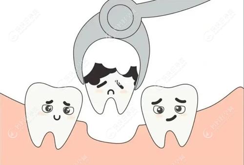 烂牙根长期不拔产生的危害须知,会埋在肉里还会导致牙龈炎