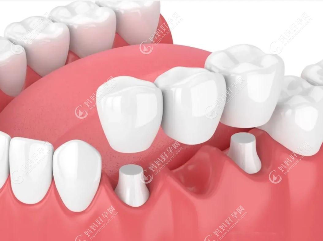 牙齿松动治疗费用大概多少钱www.mamahaoyun.com