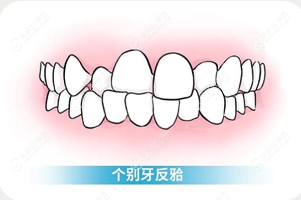 错颌畸形之个别牙反颌