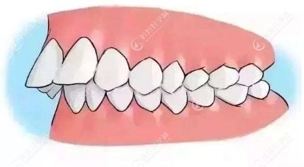 牙齿矫正拔牙一次性可以拔几颗www.mamahaoyun.com
