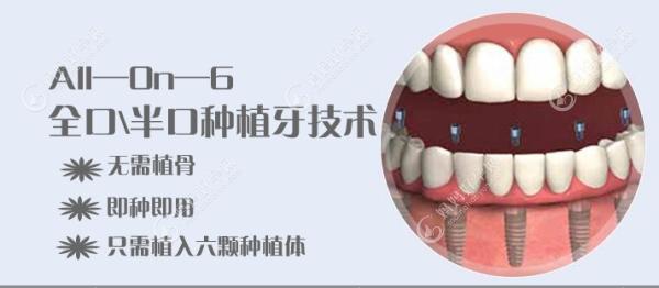 北京劲松口腔医院all-on-6半口种植牙集采价格