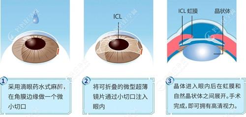 ICL晶体植入矫正近视眼过程