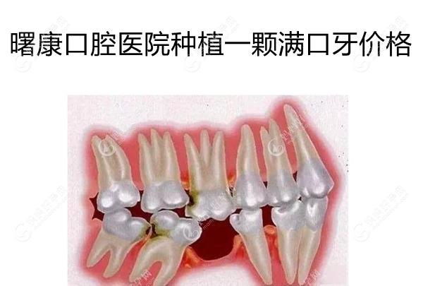 曙康口腔医院种植一颗/满口牙价格合理,种牙技术水平也不错