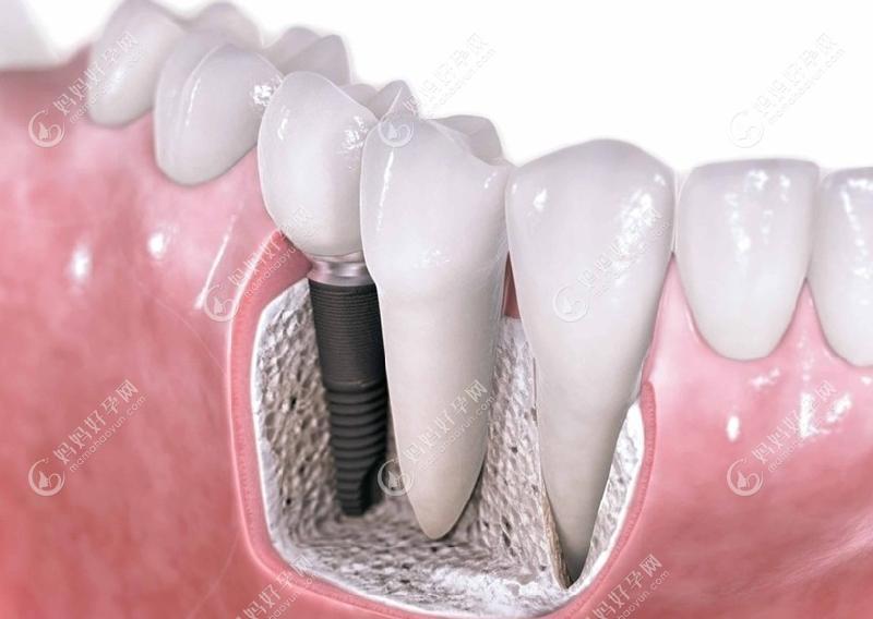 牙齿缺失做种植牙可避免流口水
