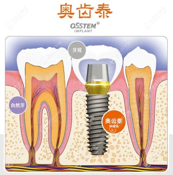 奥齿泰种植牙价格2023,韩国奥齿泰种牙费用4500起集采后便宜