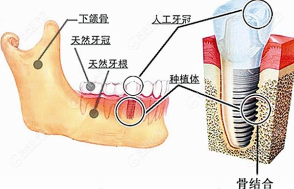 植体在牙槽骨内的图www.mamahaoyun.com
