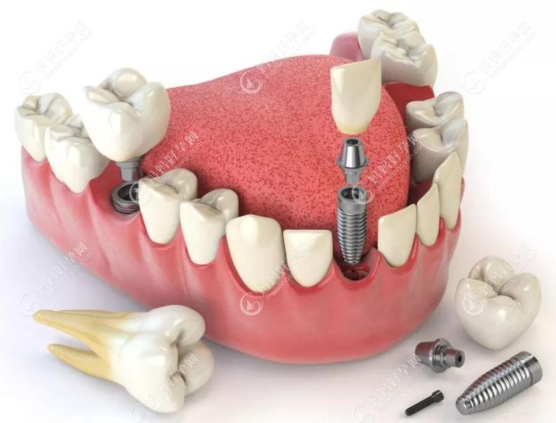 种植牙过程图示