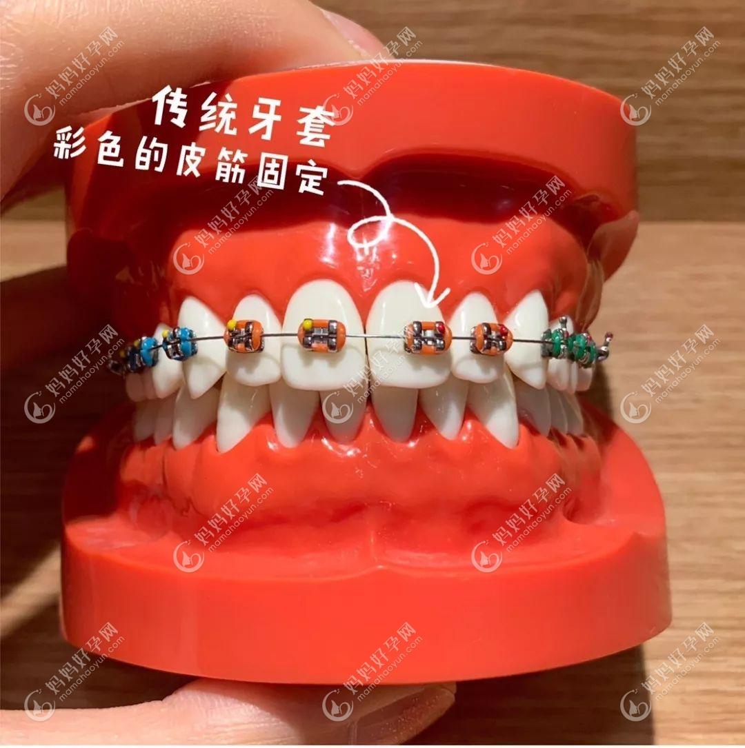 隐形牙齿矫正和传统矫正哪个更好www.mamahaoyun.com