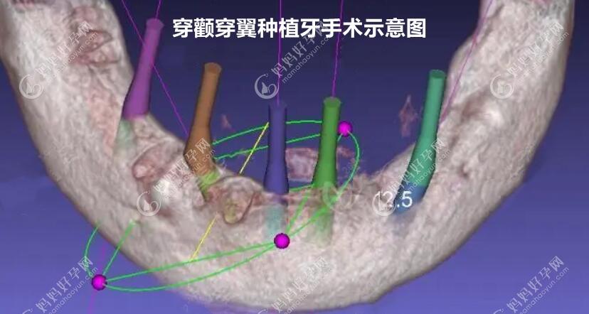 上海鼎植口腔种植牙医生大多人推荐黎强、高振华、谢正新