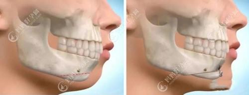 牙齿整齐可以直接做正颌吗