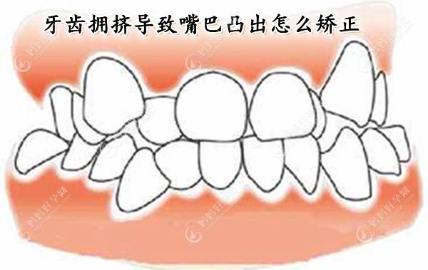 牙齿拥挤突出导致嘴巴凸出怎么矫正?牙齿拥挤可不拔牙矫正