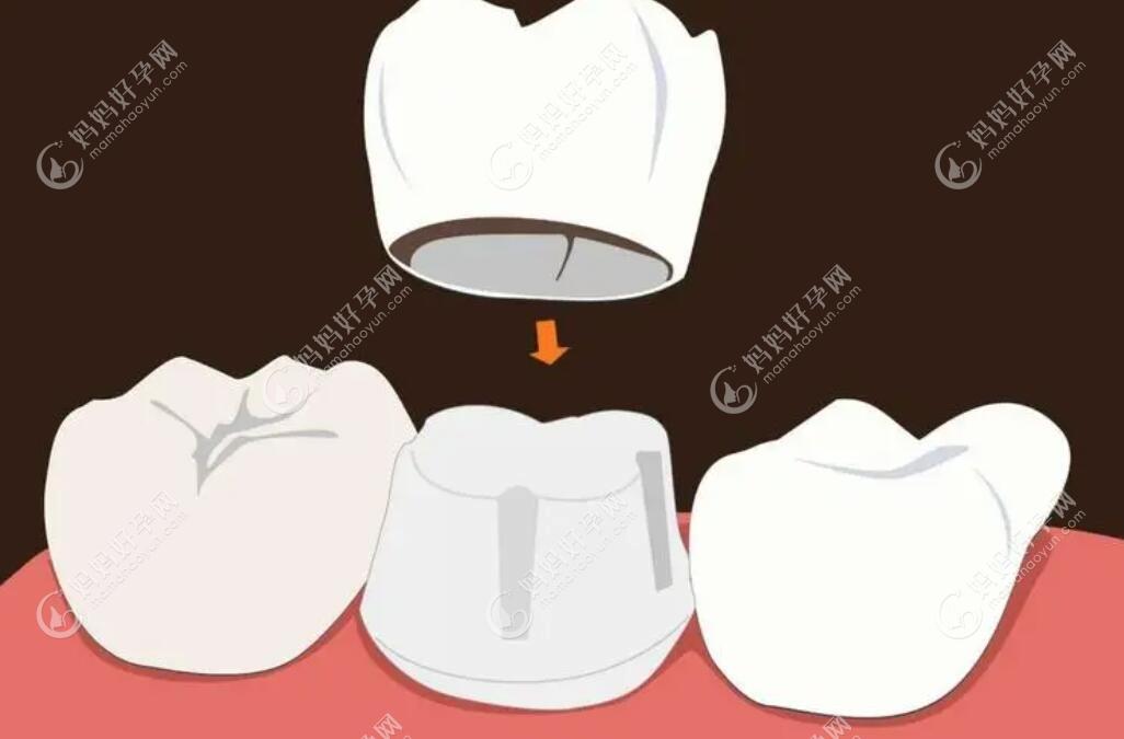 根管治疗后牙冠保护