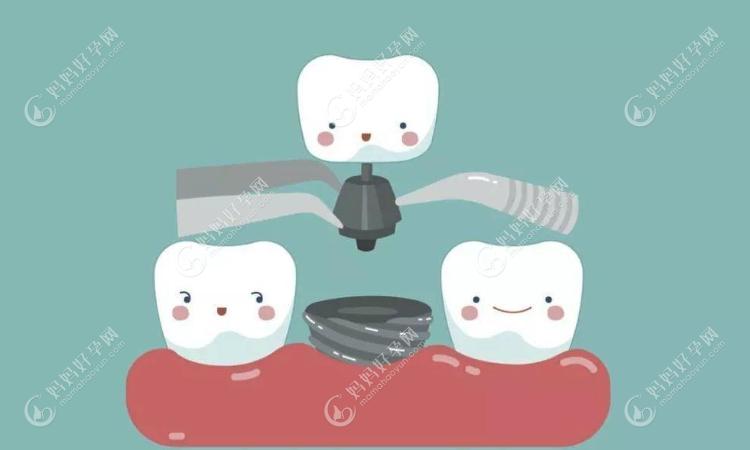 牙齿种植的弊端是什么