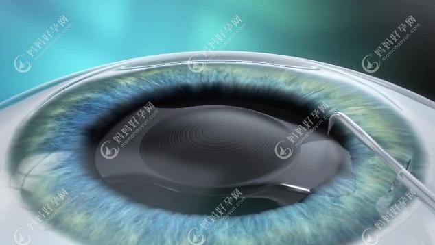 北京民众眼科晶体植入近视手术价格约3万起