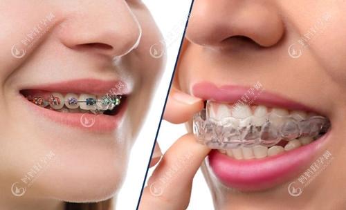 上海鼎植口腔隐形矫正牙齿价格比钢丝矫正贵的原因