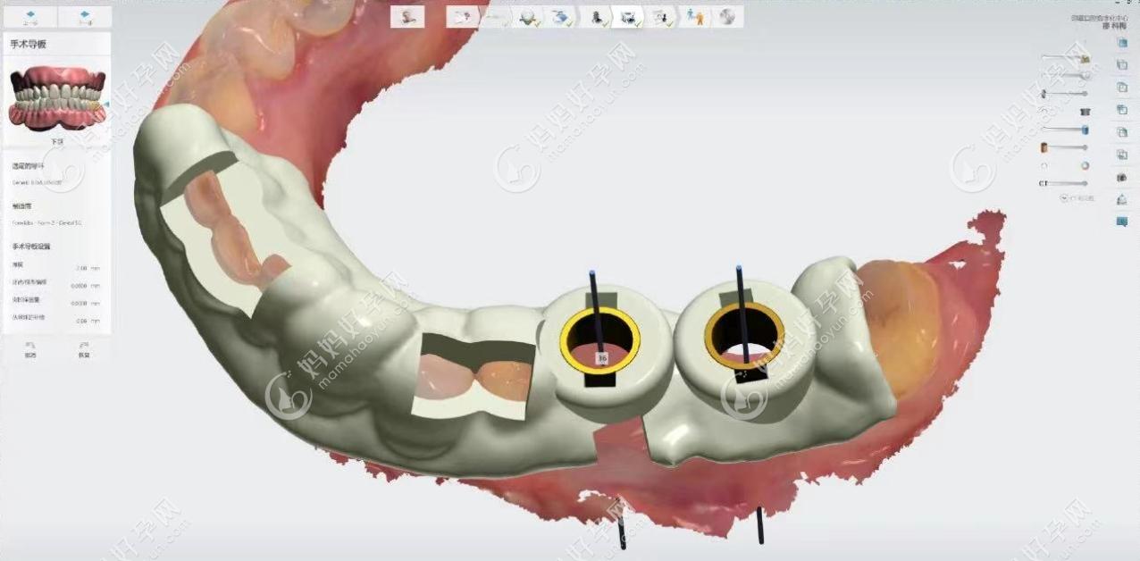 上海美奥口腔3D种植导板技术