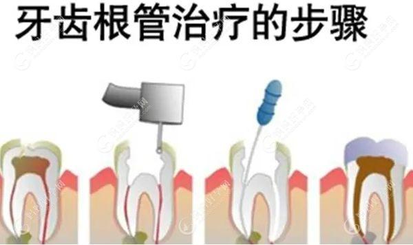 什么情况下要做根管治疗牙齿？当牙齿患牙髓炎/根尖周炎等