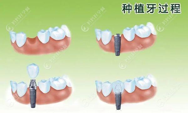 种植牙过程mamahaoyun.com