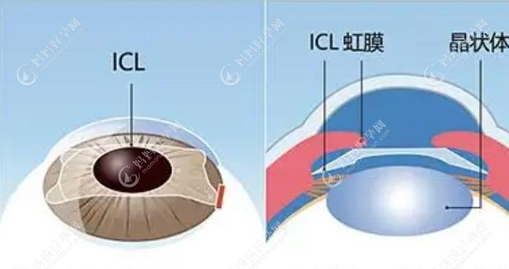 武汉做近视眼睛晶体植入价格:ICL晶体收费2w+TICL晶体收费3w+