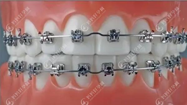 牙科矫正牙齿收费价目表:金属矫正8k+/隐形牙套1.5w+/舌侧5w起