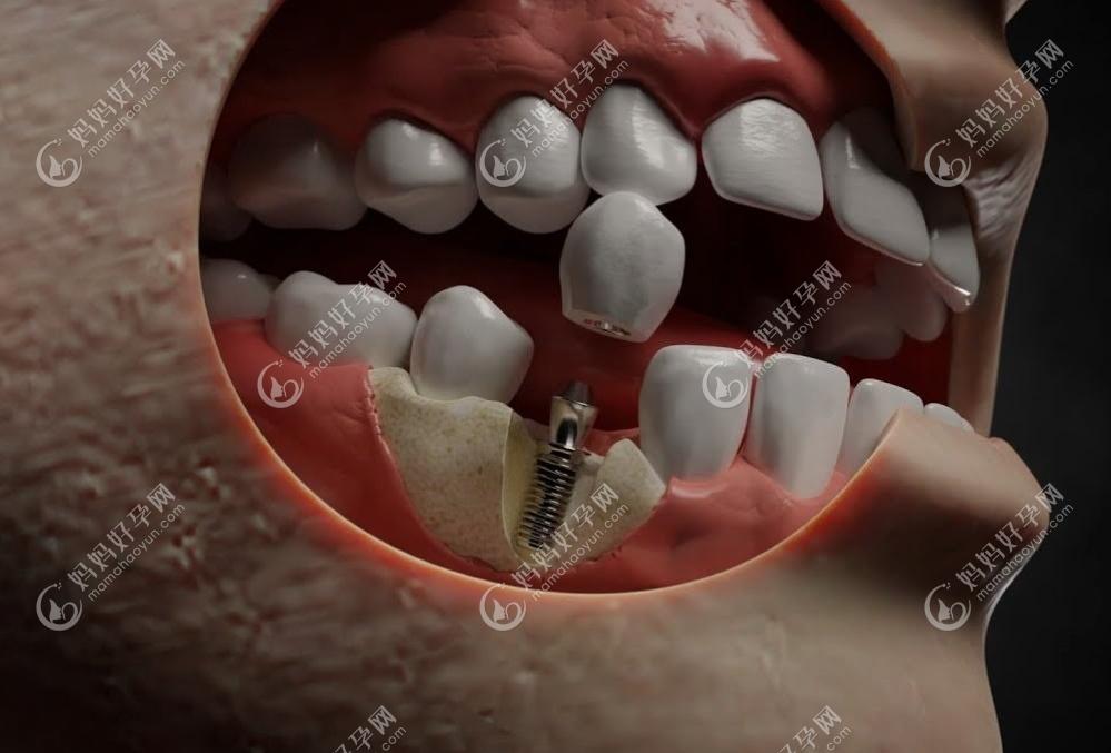 正规医院牙科收费价目表2023版,含国内种植牙多少钱一颗明细