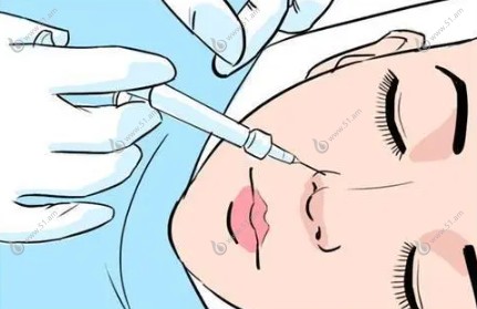 双美胶原蛋白鼻基底填充