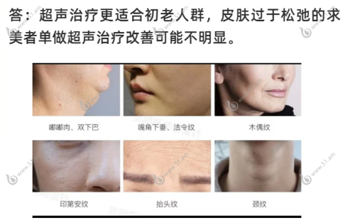 超声炮下颌线提升